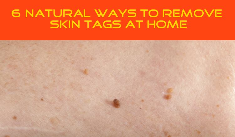 6 Natural Ways to Remove Skin Tags At Home