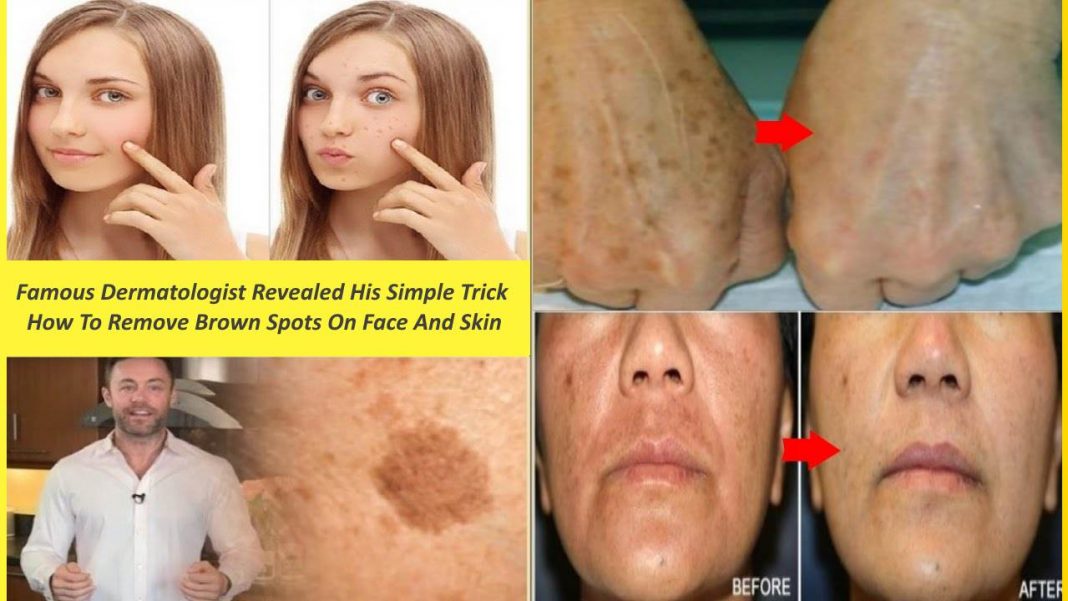 Famous Dermatologist Revealed His Simple Trick How To Remove Brown Spots On Face And Skin