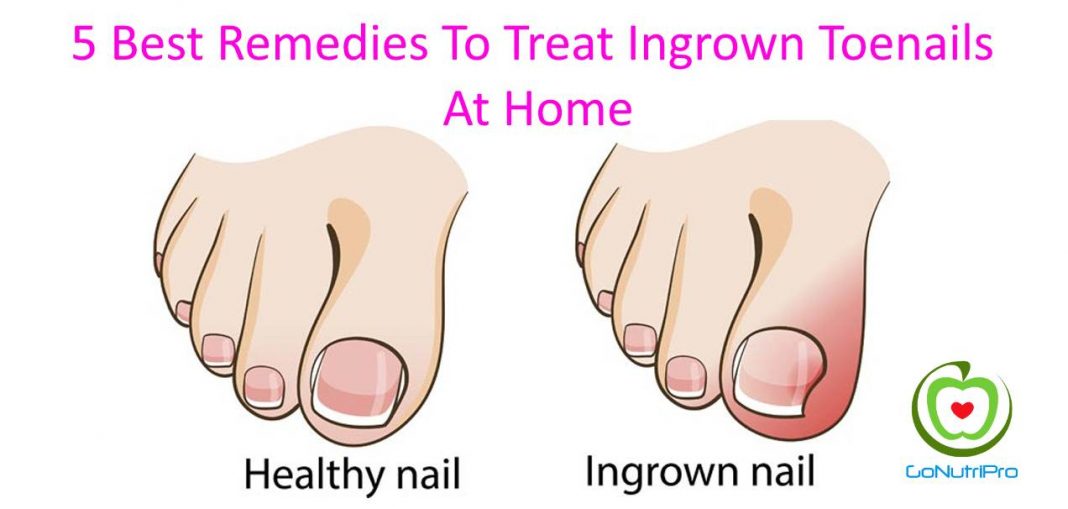 5 Best Remedies To Treat Ingrown Toenails At Home